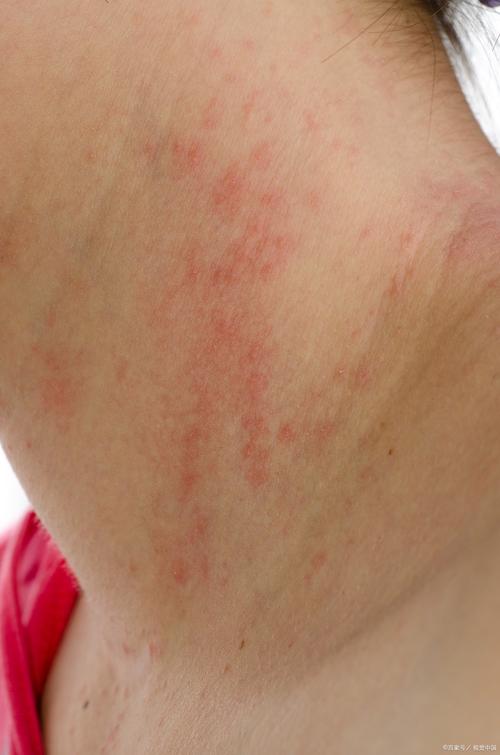 过敏性皮肤病图片大全能自诊吗?