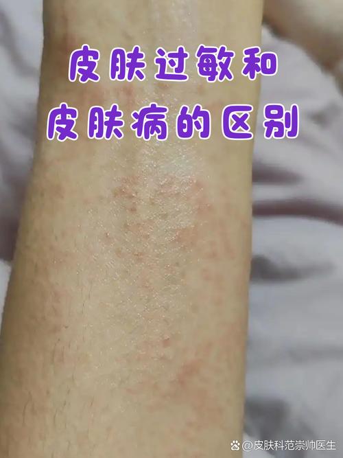 过敏性皮肤病图片大全能自诊吗?