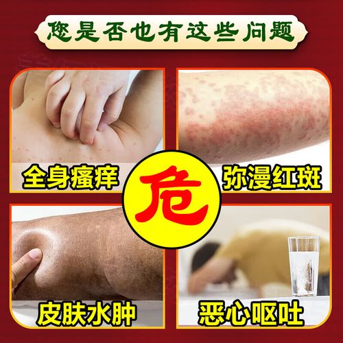 治疗皮肤过敏口服药哪种最有效?