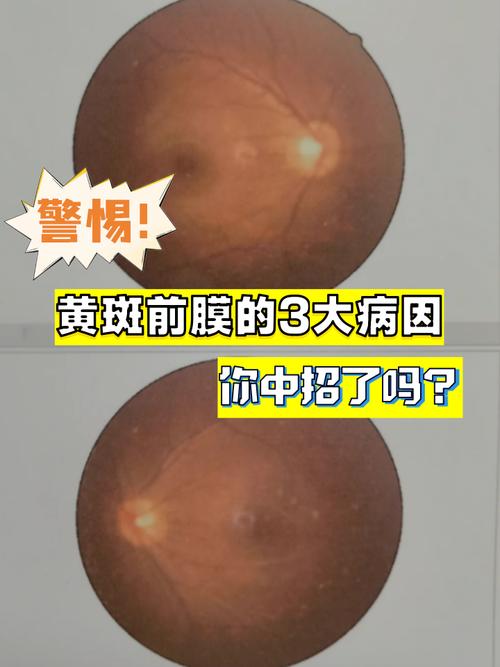 眼睛皮肤发黄是何疾病征兆?