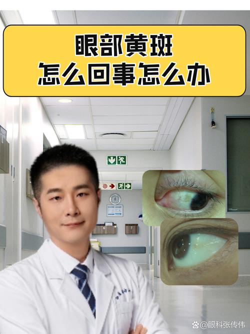 眼睛皮肤发黄是何疾病征兆?