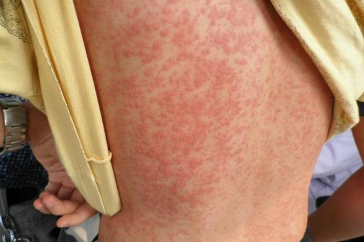 艾滋病急性期皮肤症状有哪些表现?