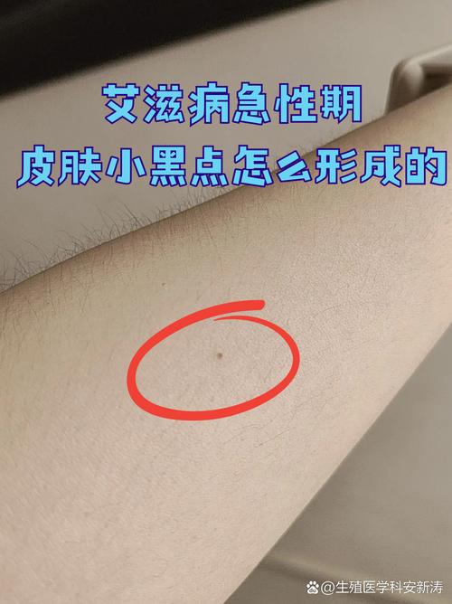 艾滋病急性期皮肤症状有哪些表现?