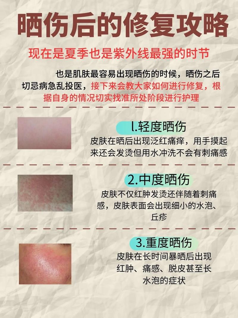 海边晒红皮肤急救妙招有哪些?