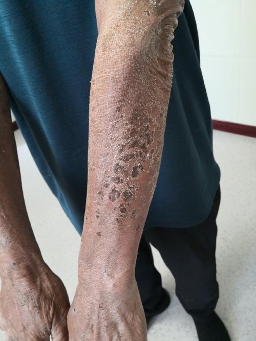 皮肤干燥起皮越抓越痒,到底该怎么缓解?