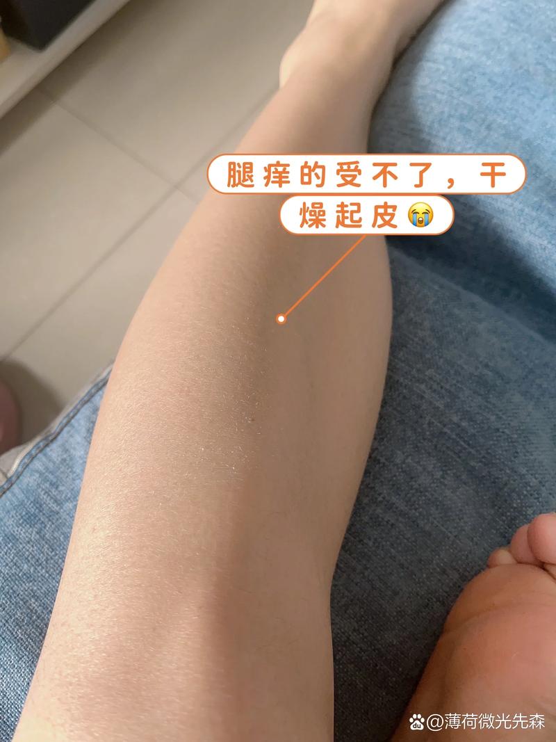 皮肤干燥起皮越抓越痒,到底该怎么缓解?