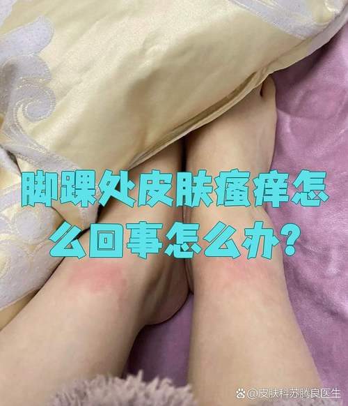 脚踝痒是皮肤病还是其他问题?