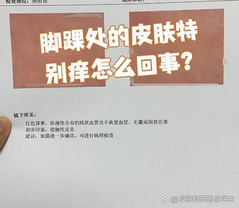 脚踝痒是皮肤病还是其他问题?