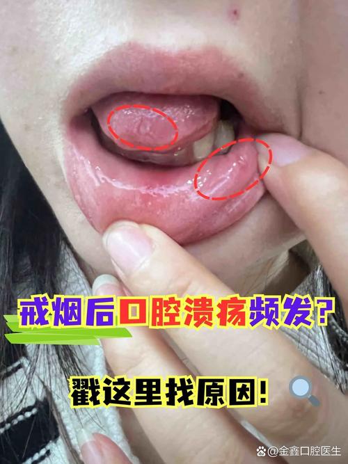 风油精治口腔溃疡真有效吗?