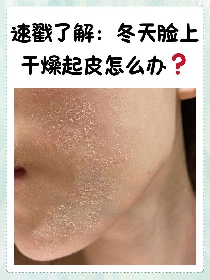 冬季皮肤干燥发痒,如何快速止痒保湿?