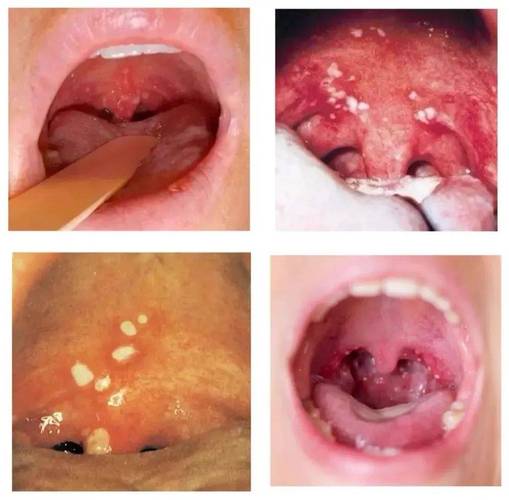 口腔溃疡和咽峡炎是一回事吗?