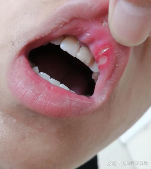 牙齿咬到唇为何总成口腔溃疡?
