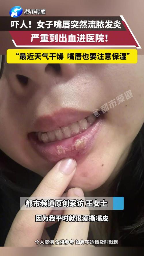 牙齿咬到唇为何总成口腔溃疡?