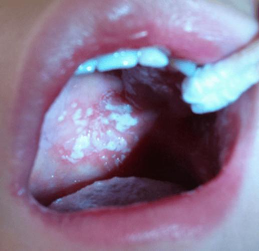 宝宝口腔发白是何原因?