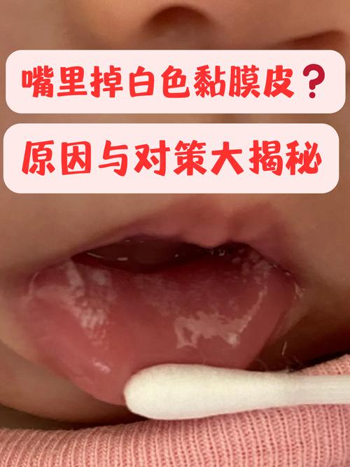 宝宝口腔发白是何原因?