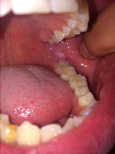 口腔内壁靠近大牙处发白是何原因?