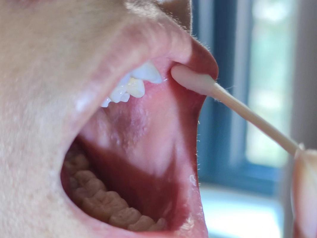 口腔内壁靠近大牙处发白是何原因?