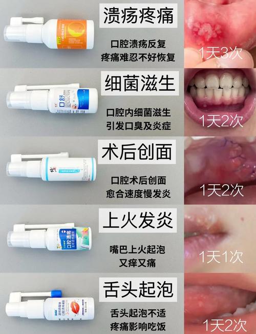 口腔溃疡喷雾哪个品牌最有效?