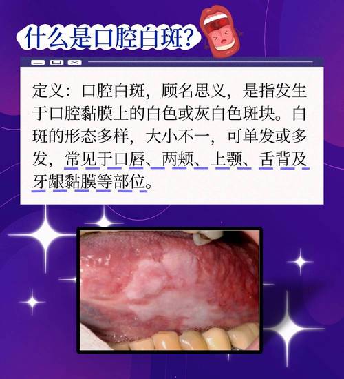 口腔内壁白点是什么原因引起的?