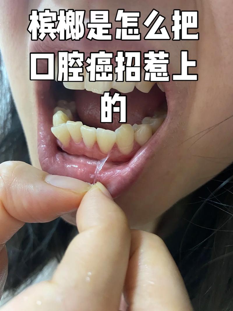 戒槟榔后口腔能恢复吗?