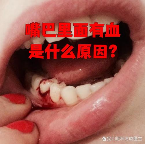 口腔都是血丝怎么回事