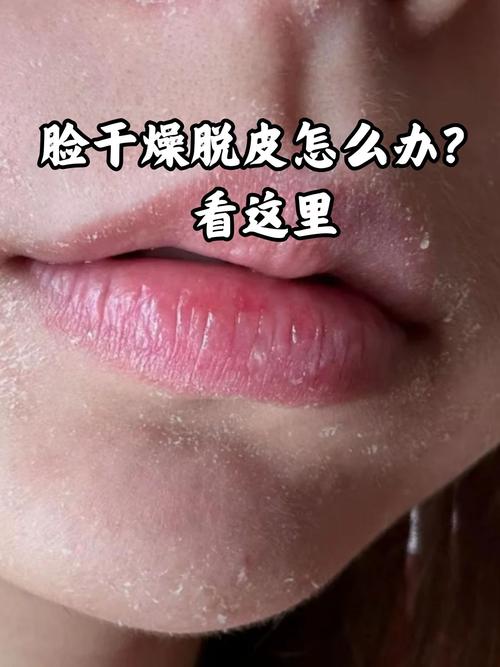 脸上皮肤特别干怎么办