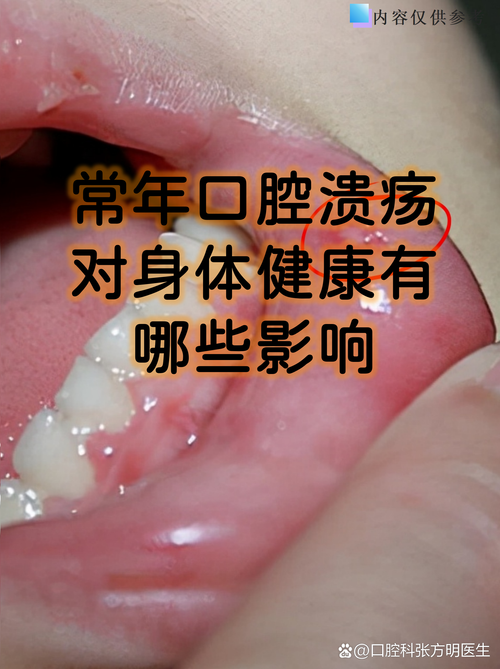 口腔溃疡常年反复不欲