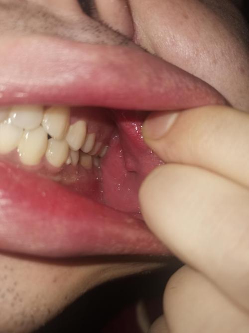 口腔有结节是什么症状