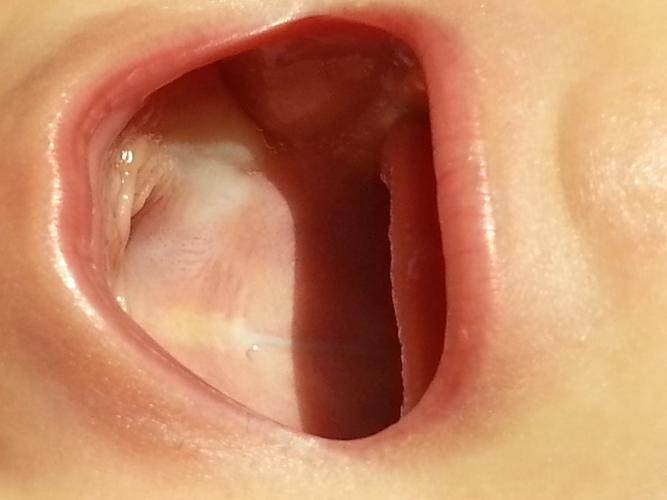 宝宝口腔上颚内壁发白