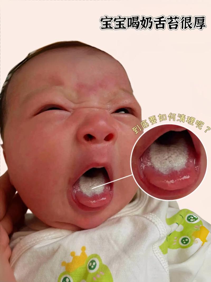 宝宝口腔上颚内壁发白