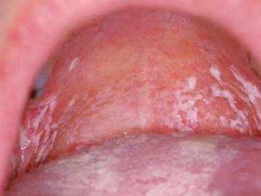 宝宝口腔上颚内壁发白