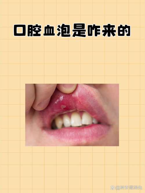 口腔出血怎么快速止血