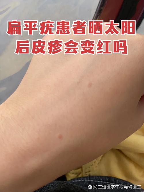 晒太阳后皮肤红痒,是过敏还是晒伤?