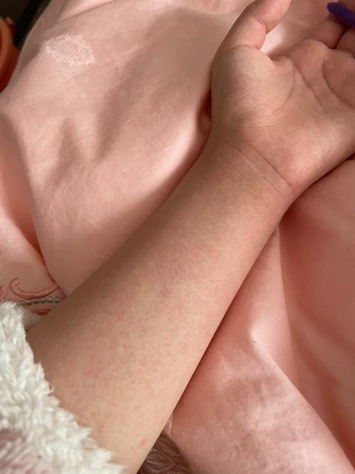 晒太阳后皮肤红痒,是过敏还是晒伤?