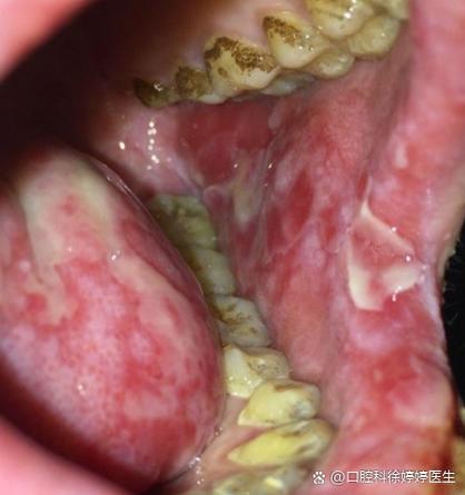 口腔内壁白斑是何原因?