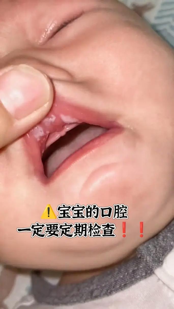 宝宝口腔内壁正常图片