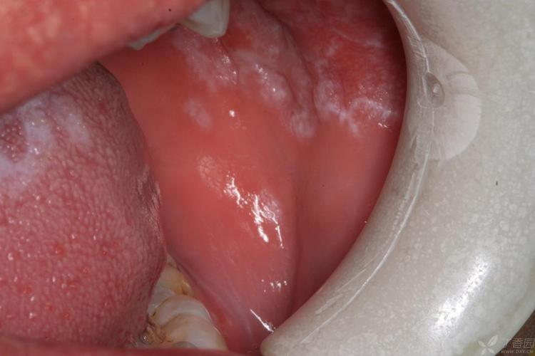 口腔舌头霉菌感染图片