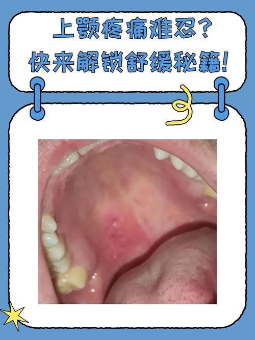 婴儿口腔上颚发黄照片