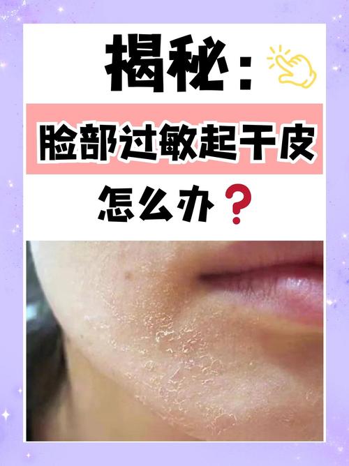 皮肤过敏脱皮怎么处理