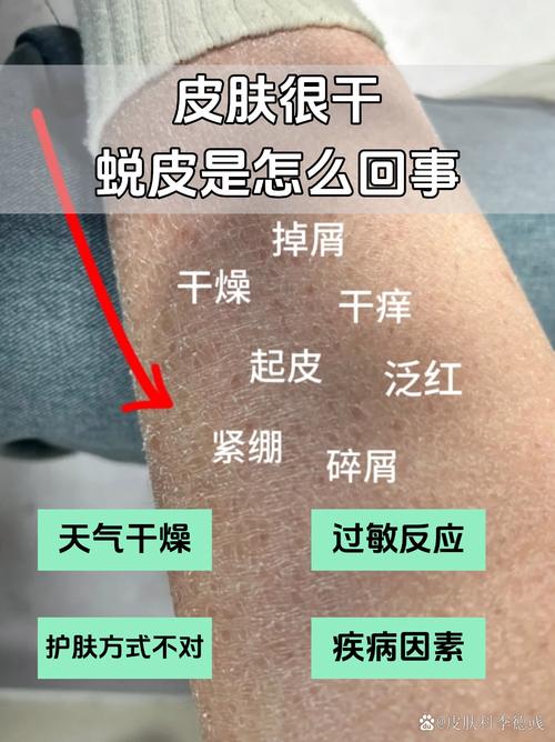 皮肤过敏脱皮怎么处理