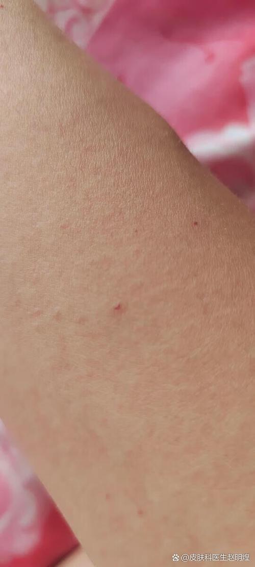 皮肤上有很多小红血点