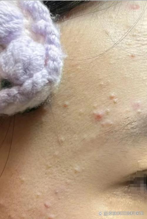 皮肤挤出的白色米粒是啥?咋形成的?