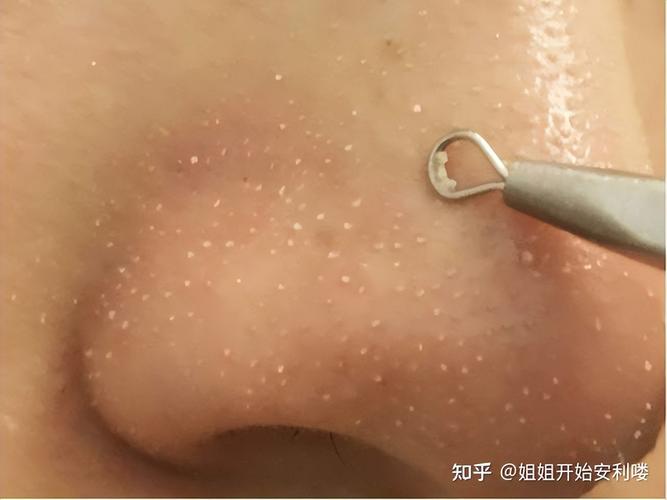 皮肤挤出的白色米粒是啥?咋形成的?