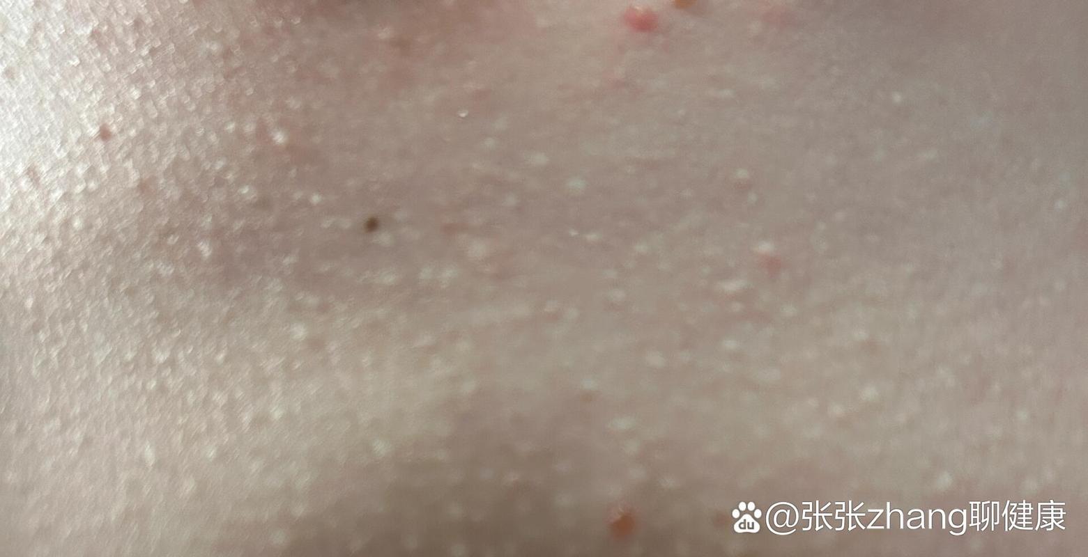 皮肤挤出的白色米粒是啥?咋形成的?