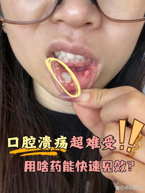 口腔溃疡戳破好的快吗