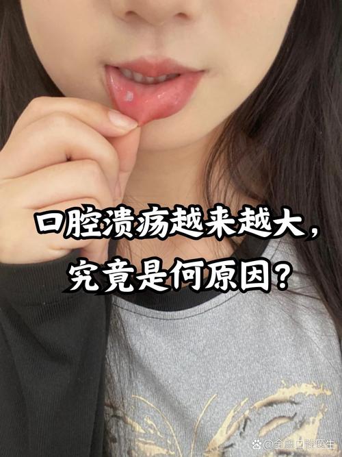 口腔溃疡为何总复发?