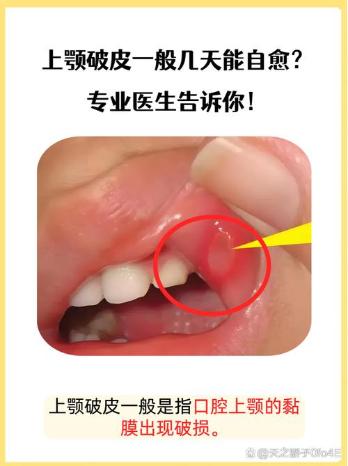 口腔黏膜烫掉皮怎么办?