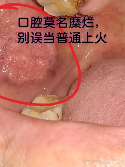 口腔黏膜烫掉皮怎么办?