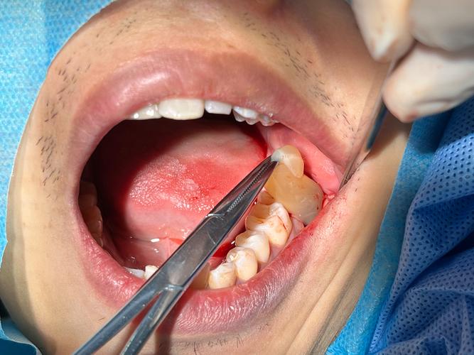 口腔伤口愈合到底要多久?