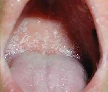 口腔白念球菌如何判断?